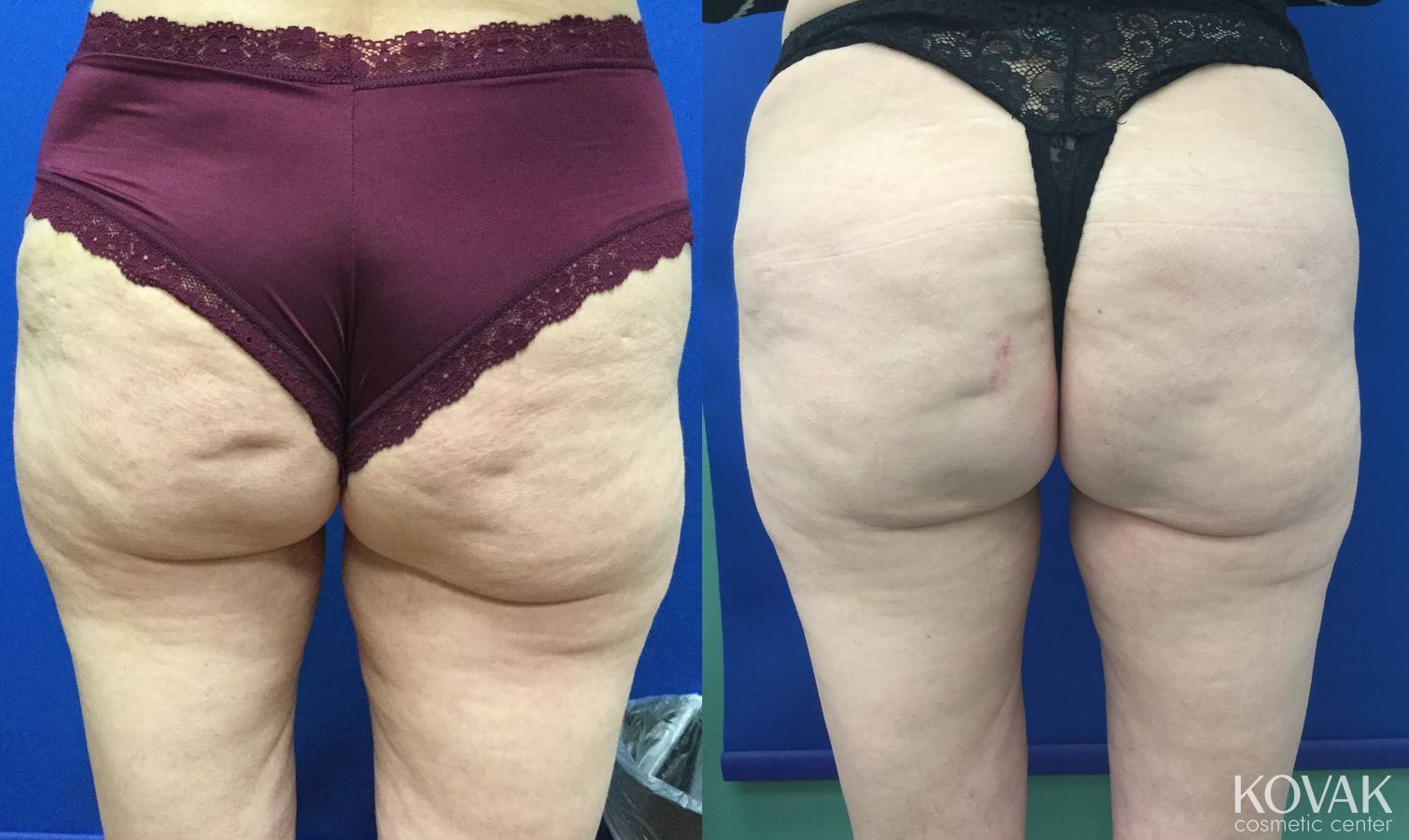 Before and after EMSCULPTĀ® case 36686 - Angle 2