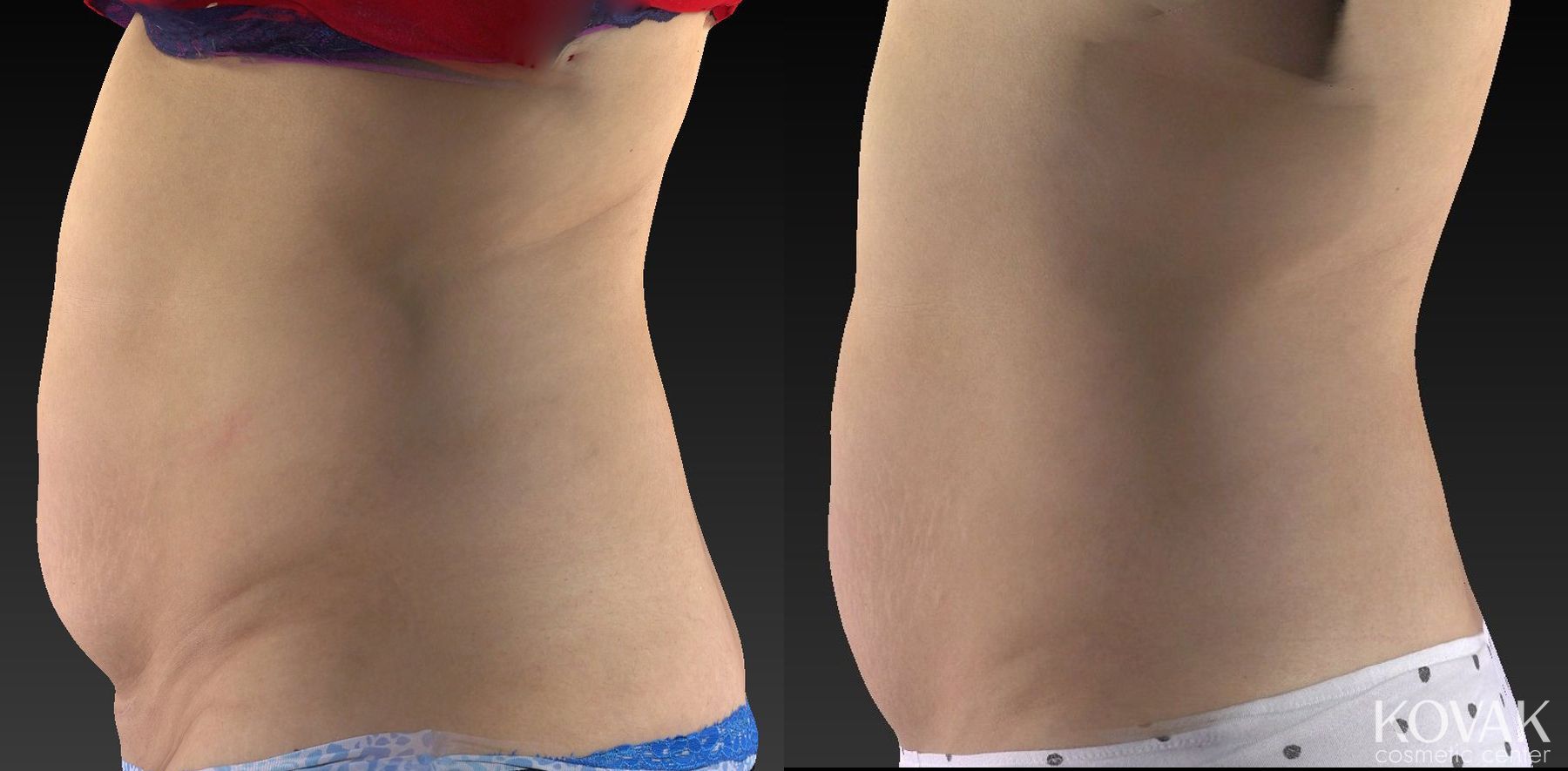 Before and after CoolSculpting® case 36602 - Angle 2