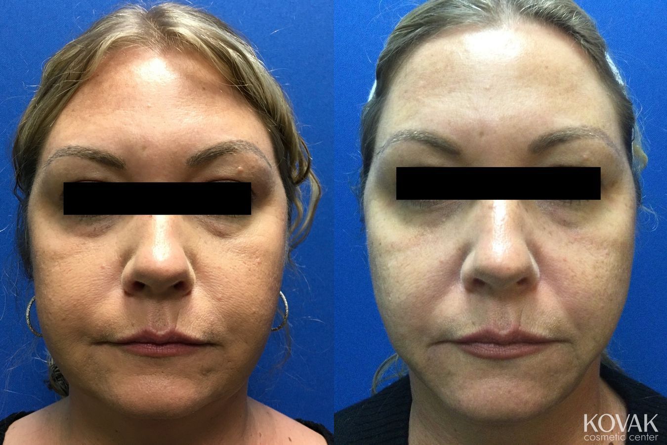 Before and after Laser Liposuction case 36738