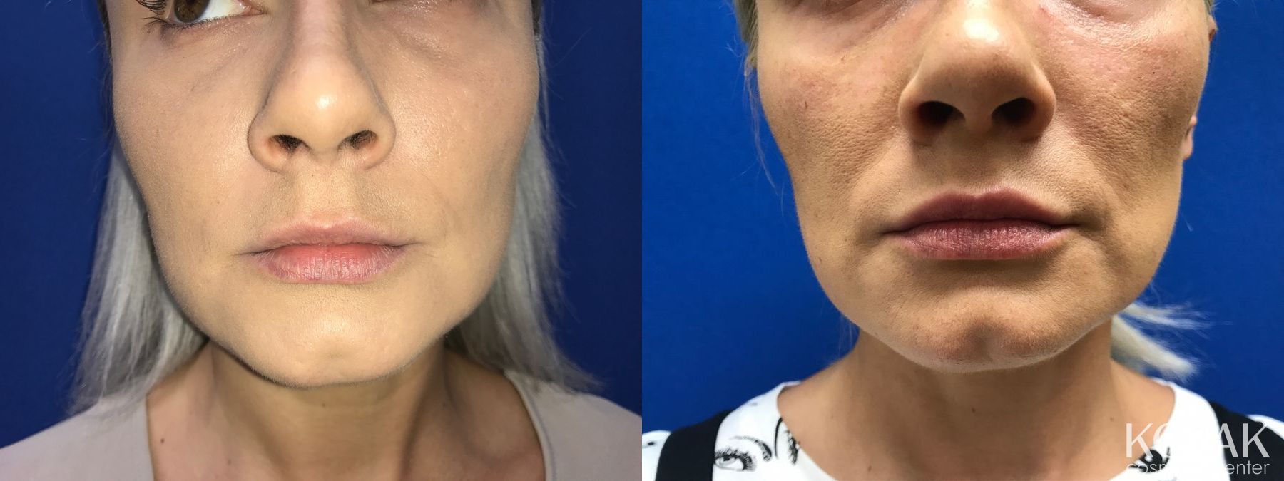 Before and after Restylane® Silk case 36570