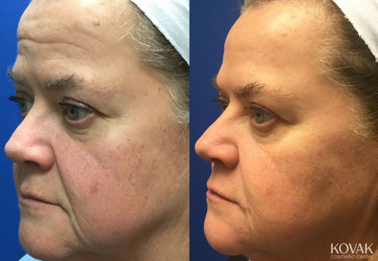 Before and after Restylane® Silk case 36645 - Angle 2