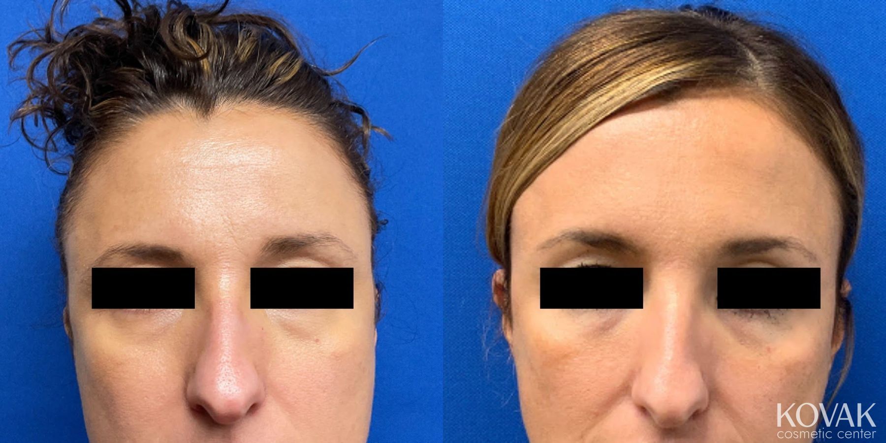 Before and after SylfirmX case 36756