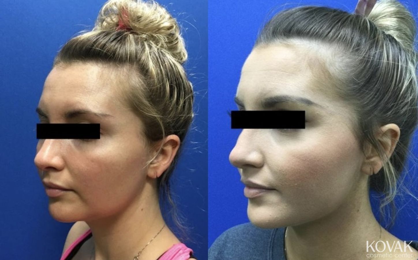 Before and after VLR - Vaser Laser - Jawline Sculpting case 36754