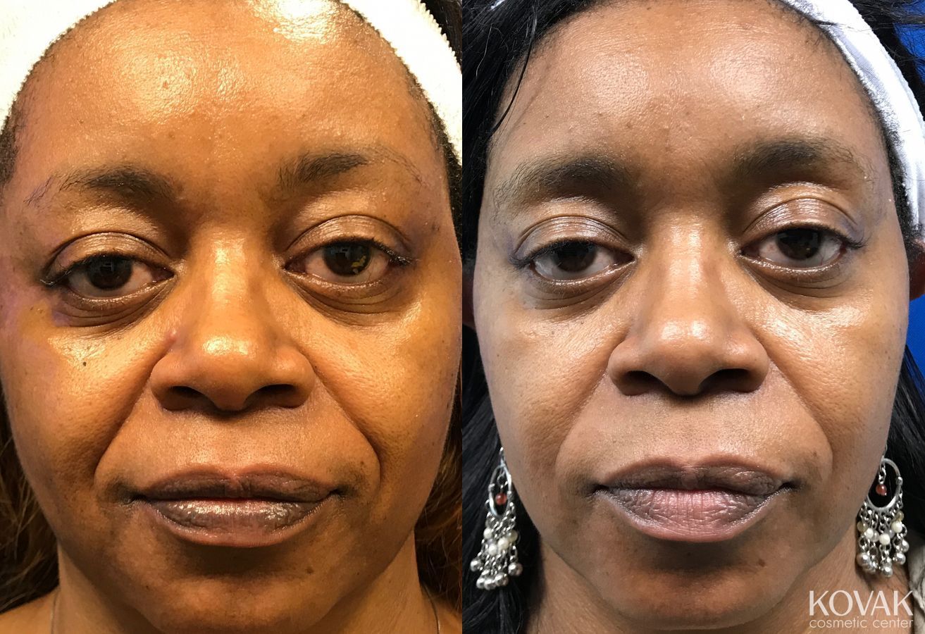 Before and after Lip Augmentation case 36563