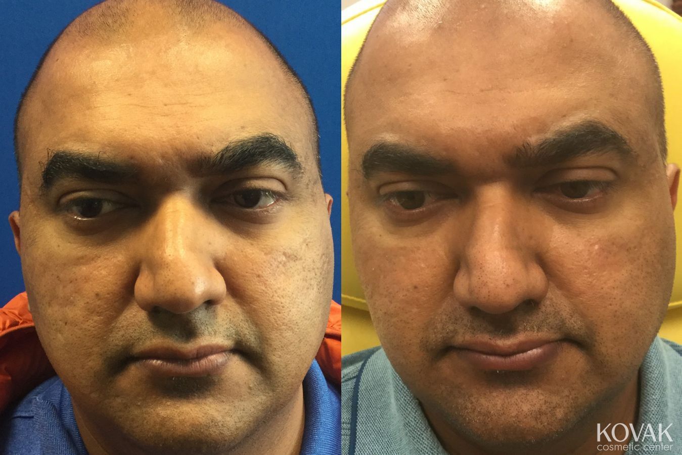 Before and after Juvéderm® XC case 36565
