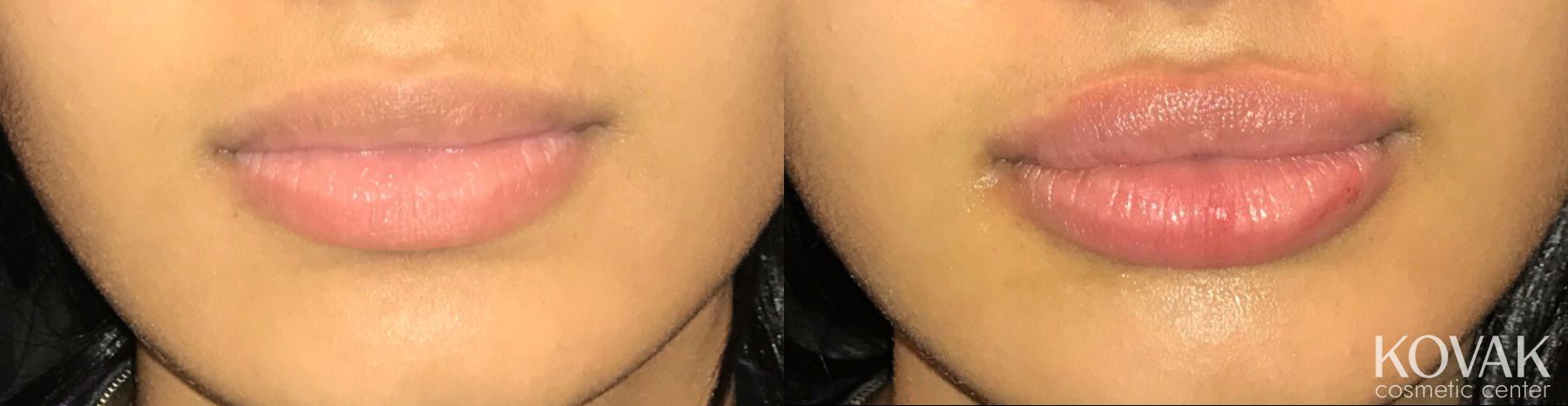 Before and after Restylane® case 36558