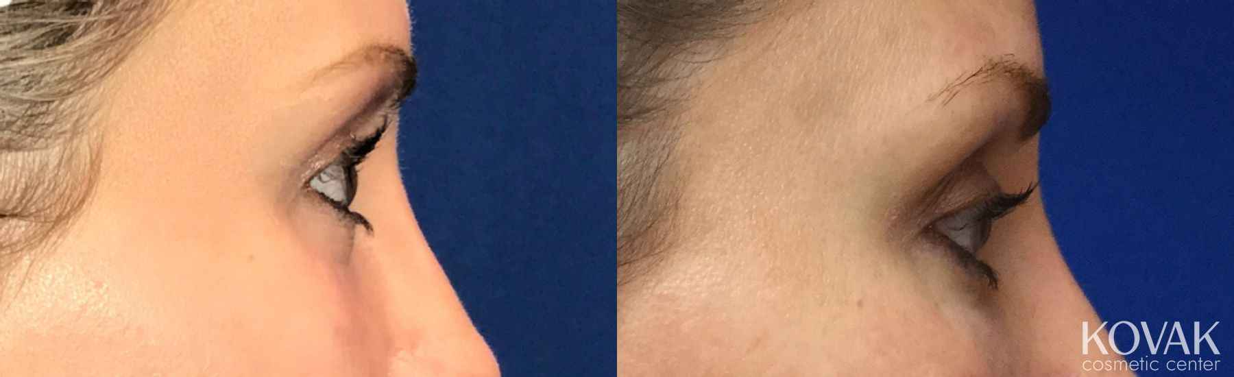 Before and after ThermiSmooth® case 36586 - Angle 3