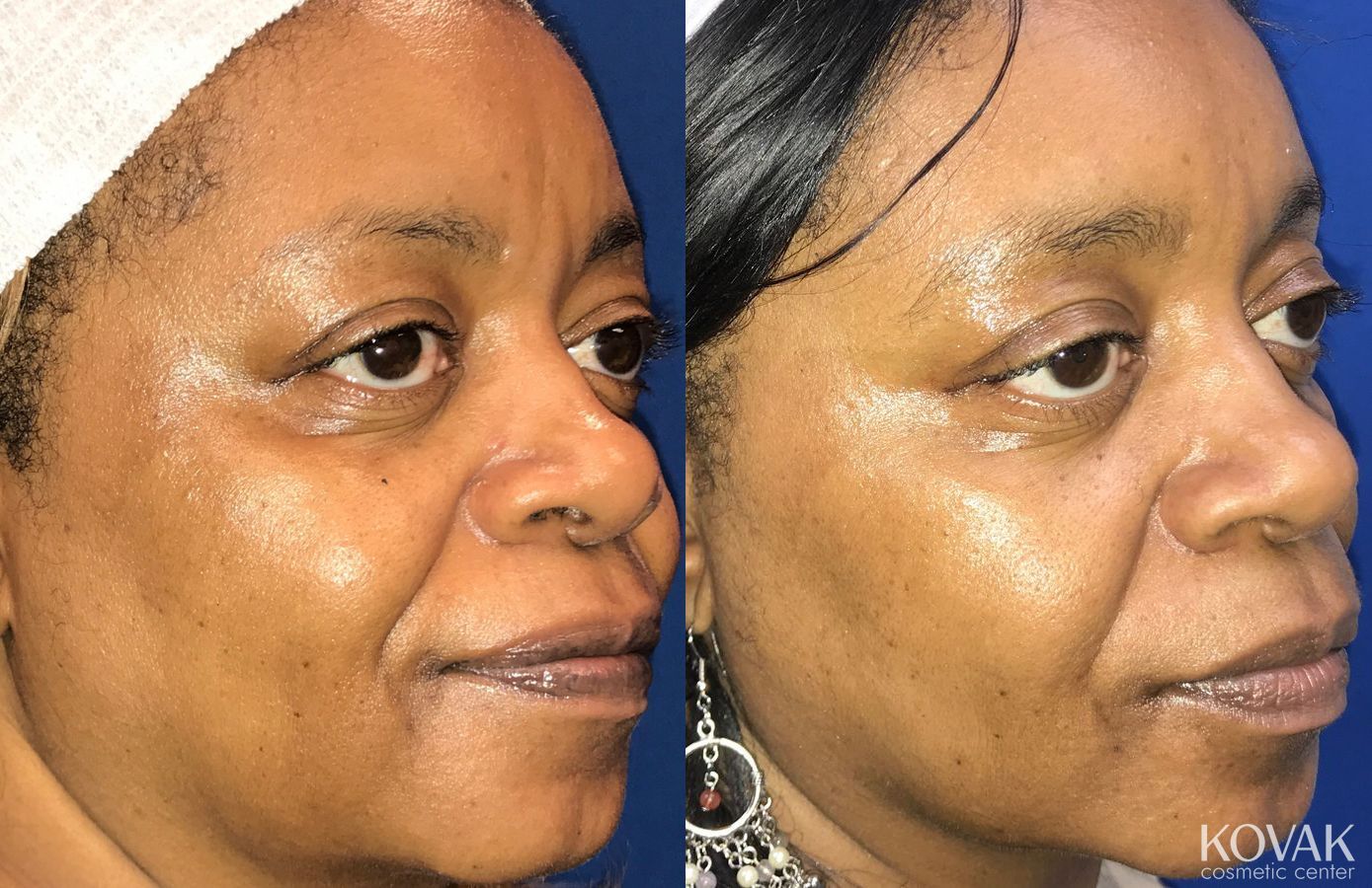 Before and after Lip Augmentation case 36563 - Angle 3
