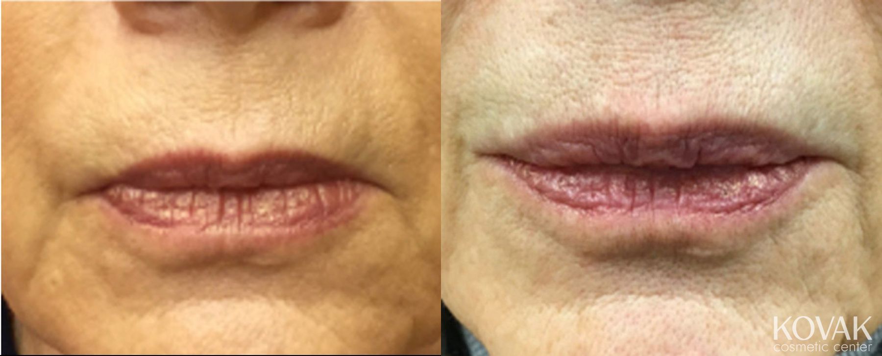Before and after Restylane® Silk case 36513