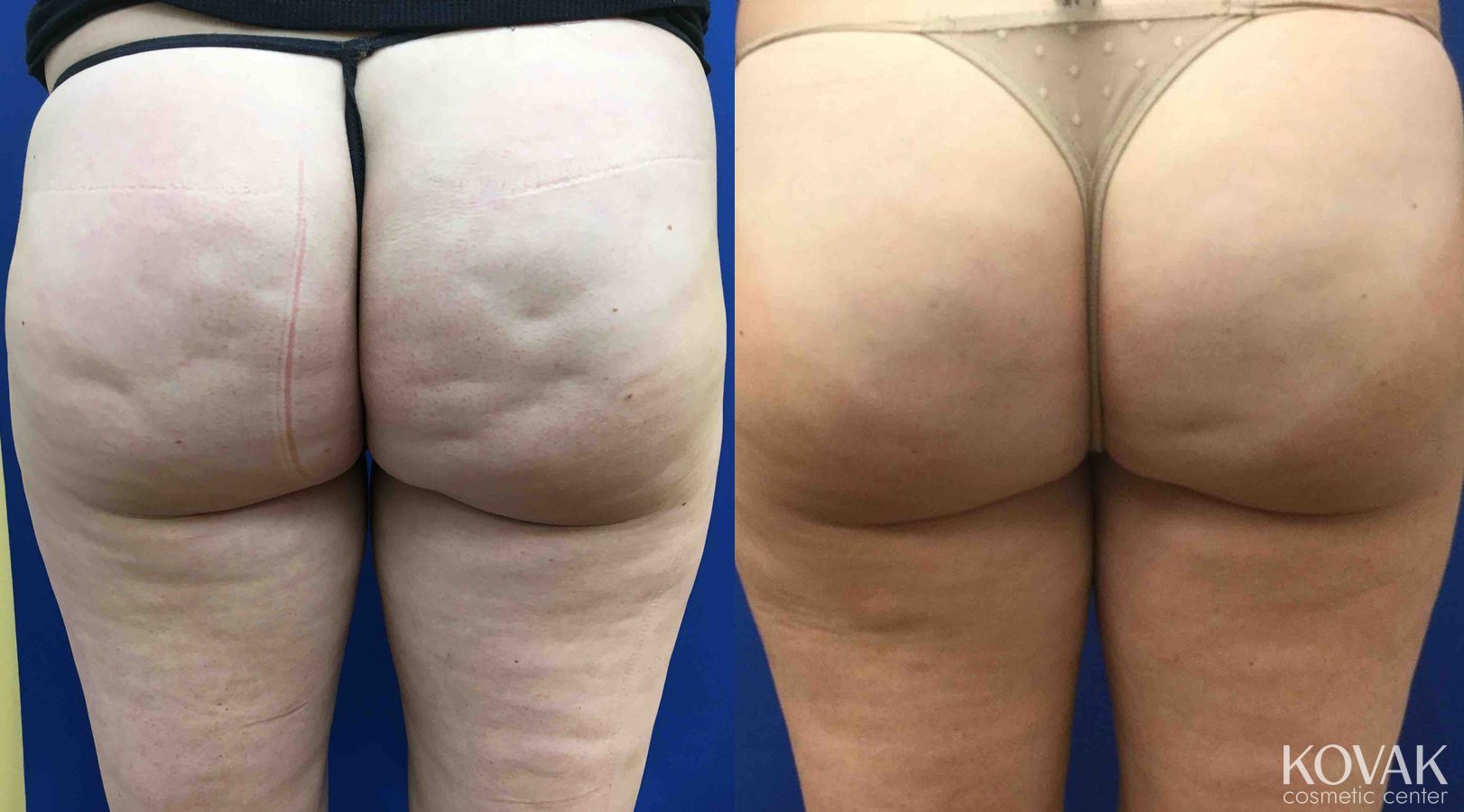 Before and after Cellulite Reduction case 36632