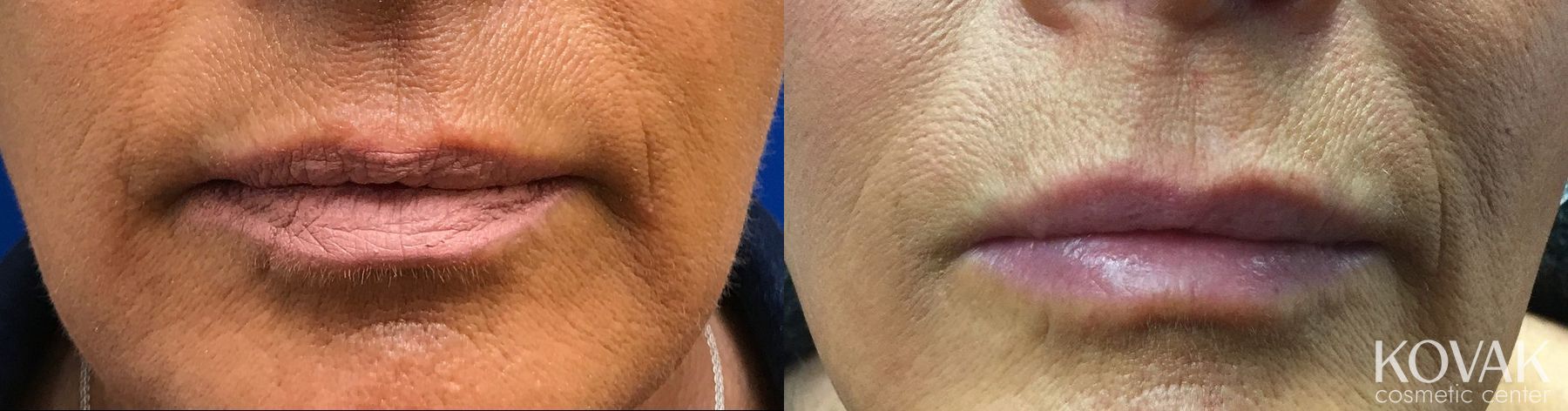 Before and after Lip Augmentation case 36668