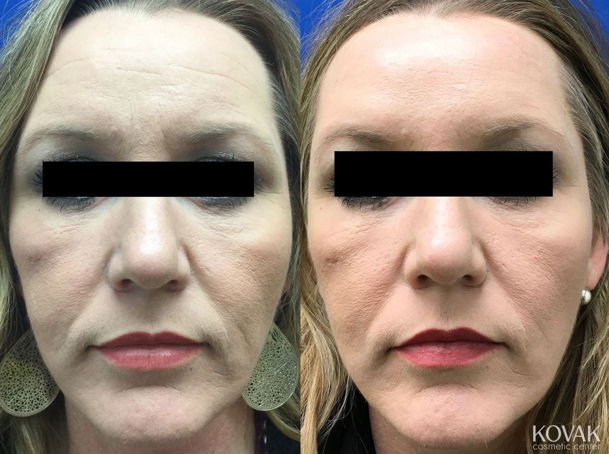 Before and after BOTOX® Cosmetic case 36678