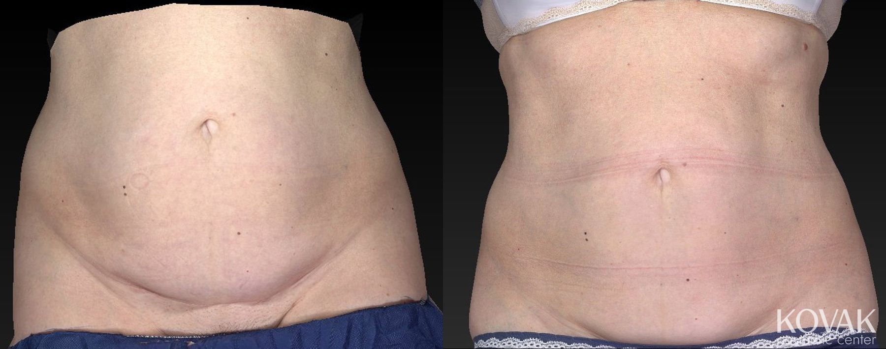 Before and after CoolSculpting® case 36485