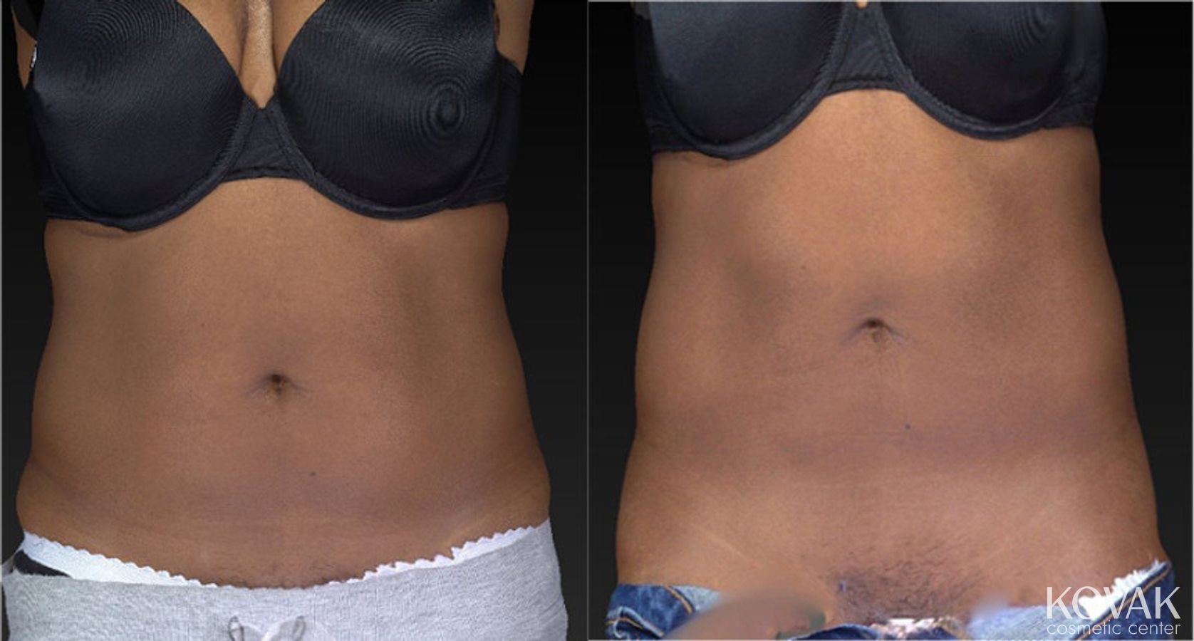 Before and after CoolSculpting® case 36505