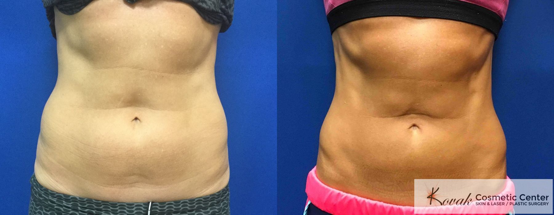 CoolSculpting® - Case 1591