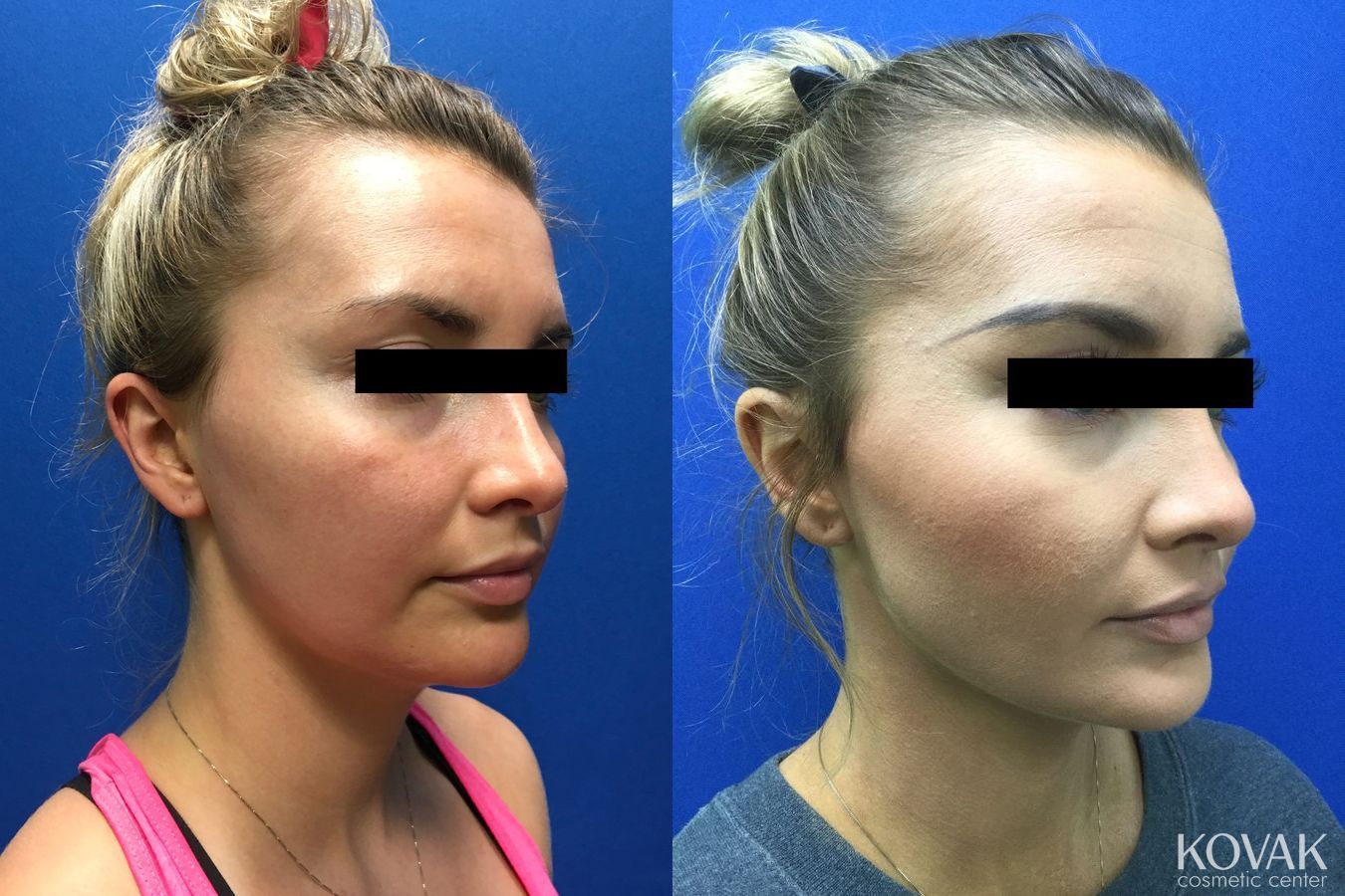 Before and after Laser Liposuction case 36705 - Angle 2