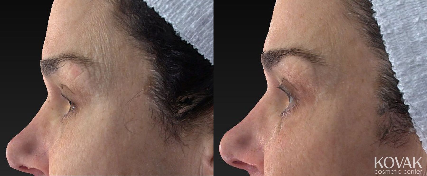 Before and after Laser Skin Resurfacing - Face case 36594 - Angle 2