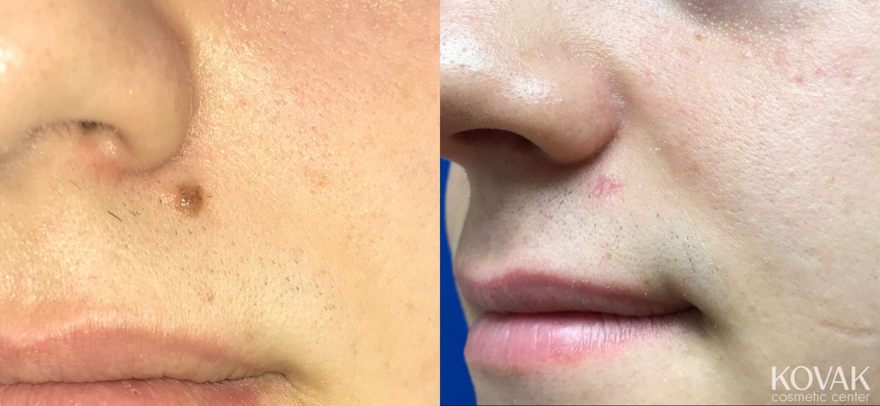Before and after Mole Removal case 36578
