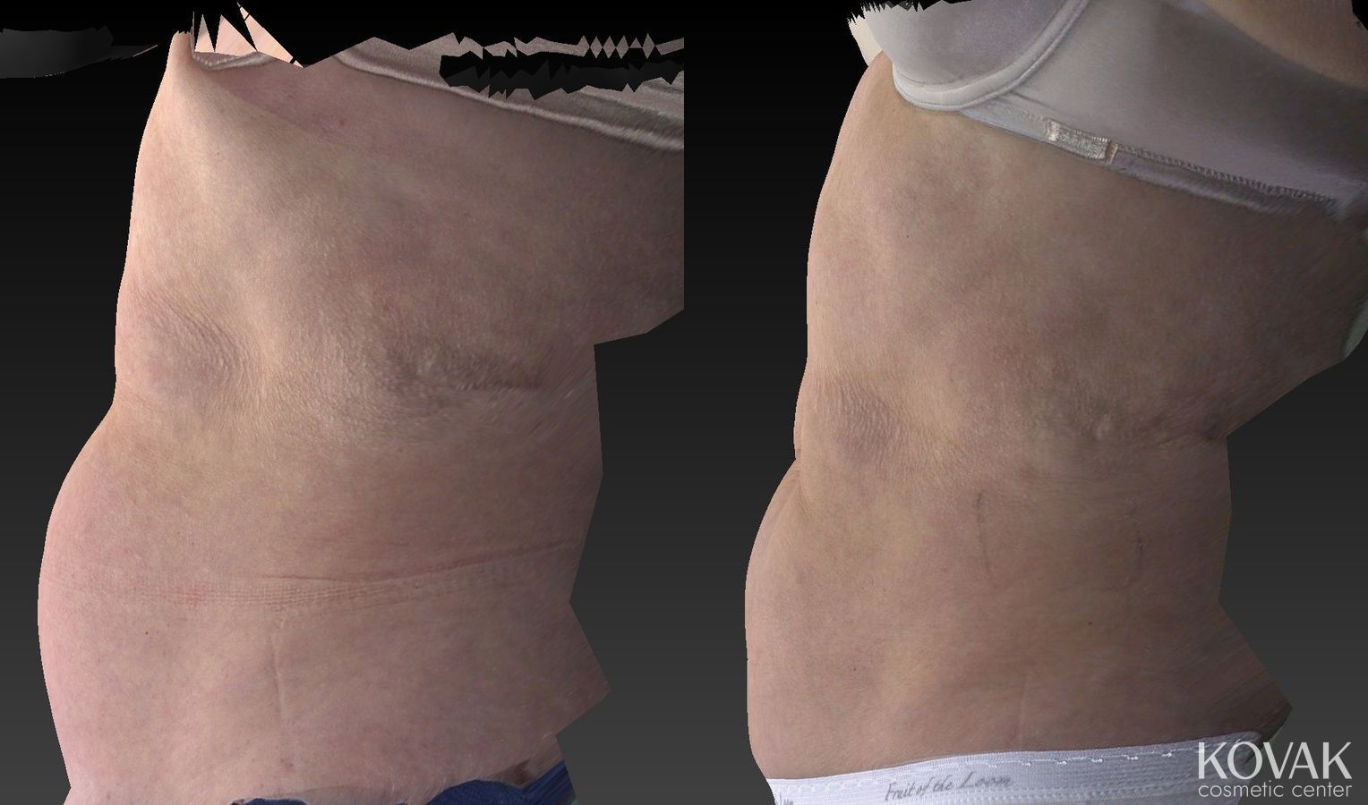 Before and after CoolSculpting® case 36484 - Angle 2