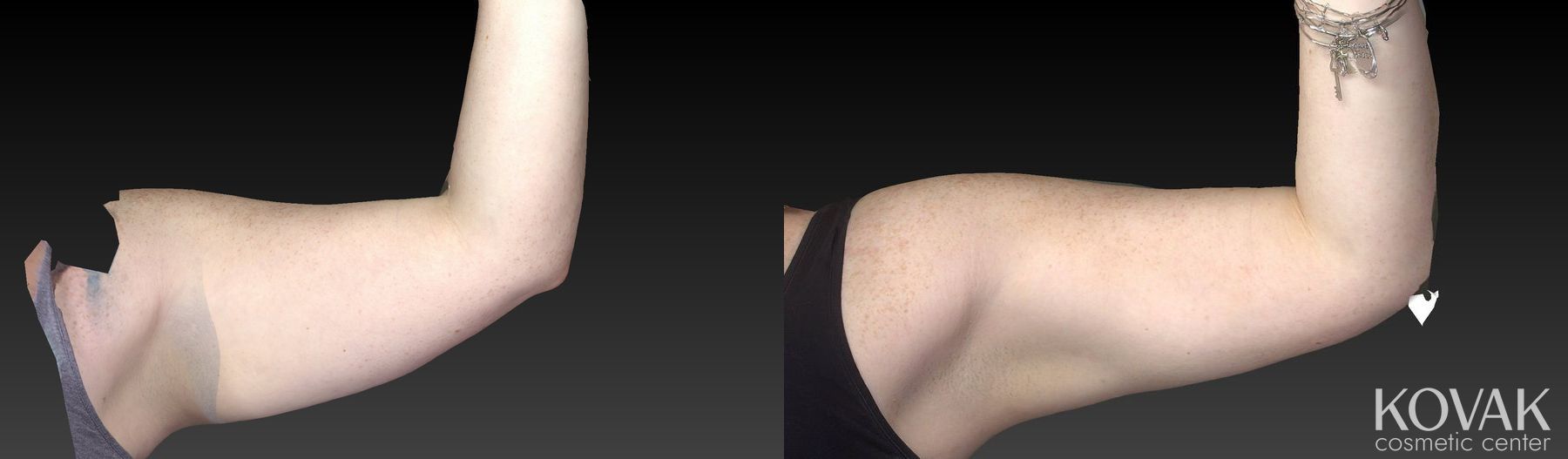 Before and after CoolSculpting® case 36593 - Angle 3