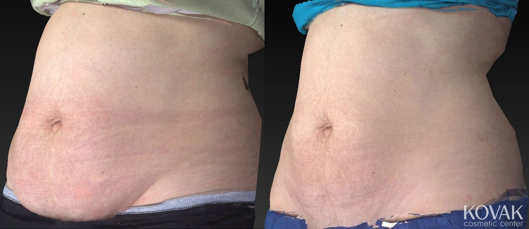 Before and after CoolSculpting® case 36459 - Angle 4