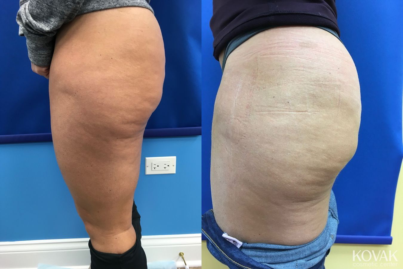 Before and after Cellulite Reduction case 36664 - Angle 3