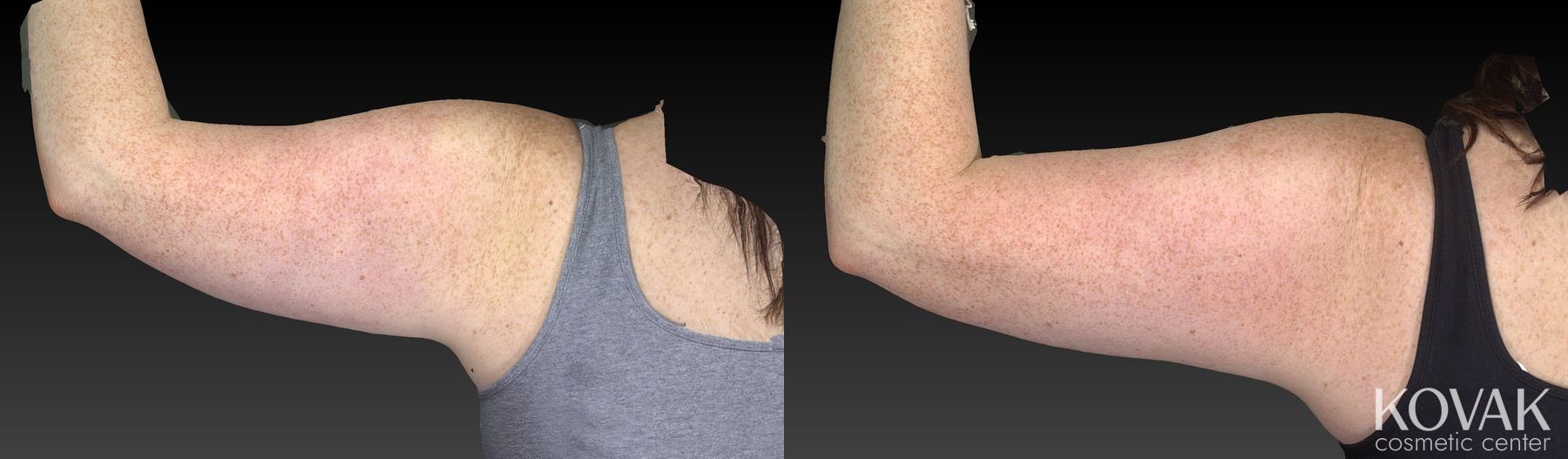 Before and after CoolSculpting® case 36593