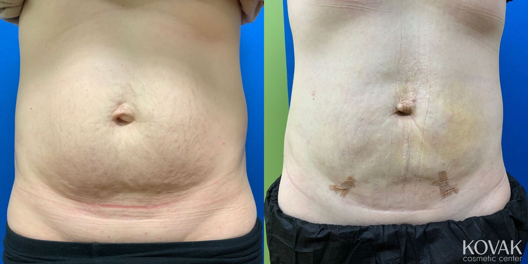 Before and after Laser Liposuction case 36725