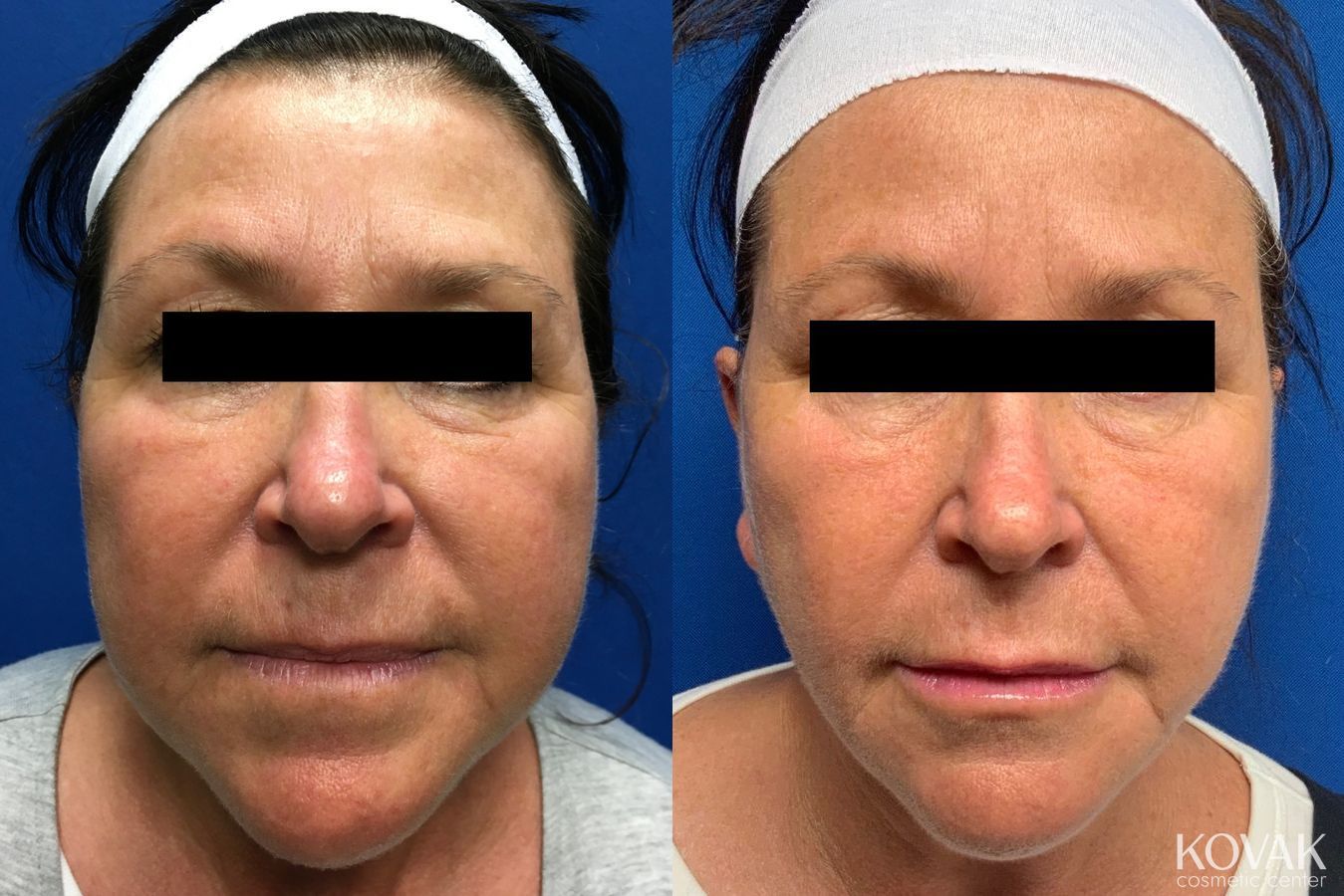 Before and after Laser Liposuction case 36743