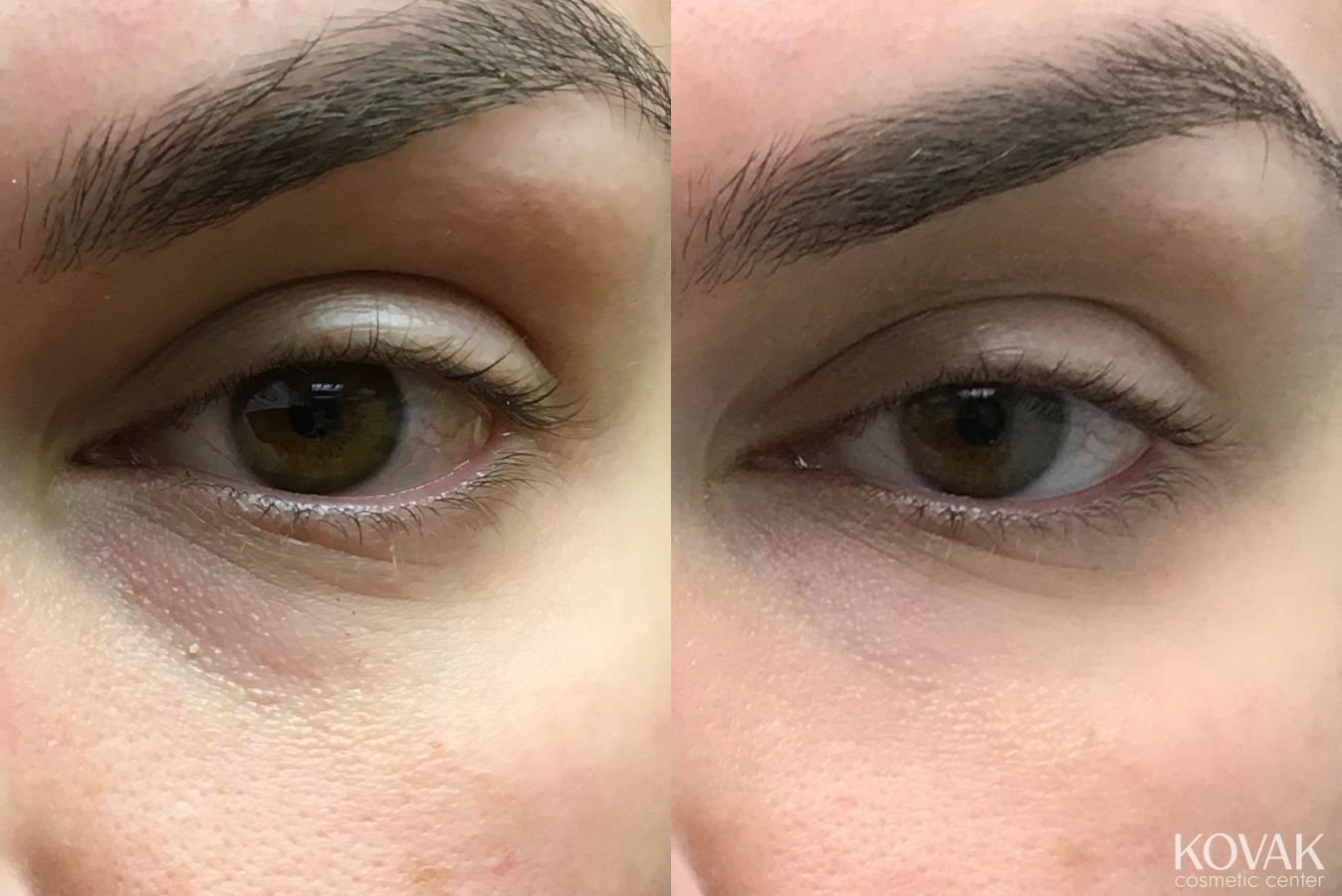 Before and after Eye Treatments case 36680 - Angle 2