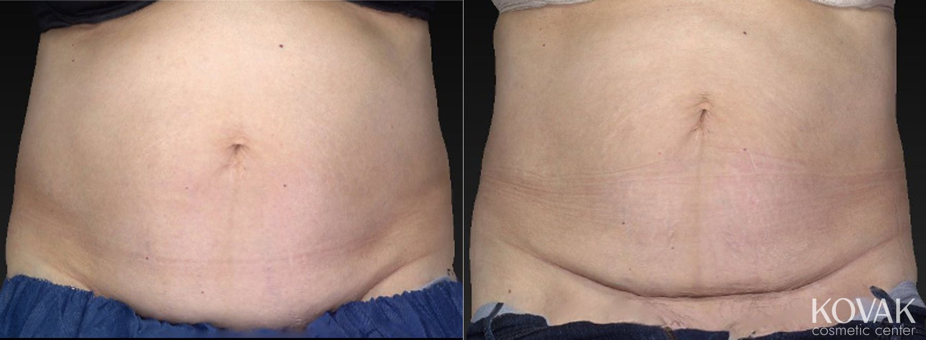 Before and after CoolSculpting® case 36480