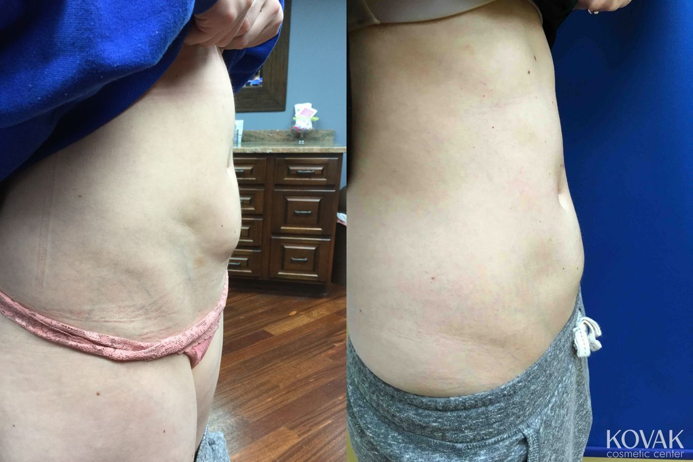 Before and after Laser Liposuction case 36613 - Angle 2