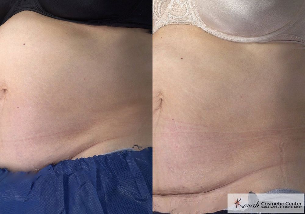 CoolSculpting® - Thumbnail 5