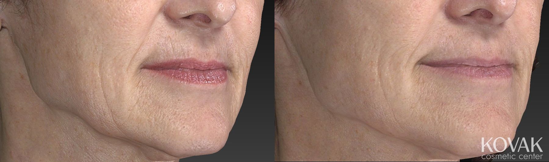 Before and after Restylane® Silk case 36462 - Angle 5