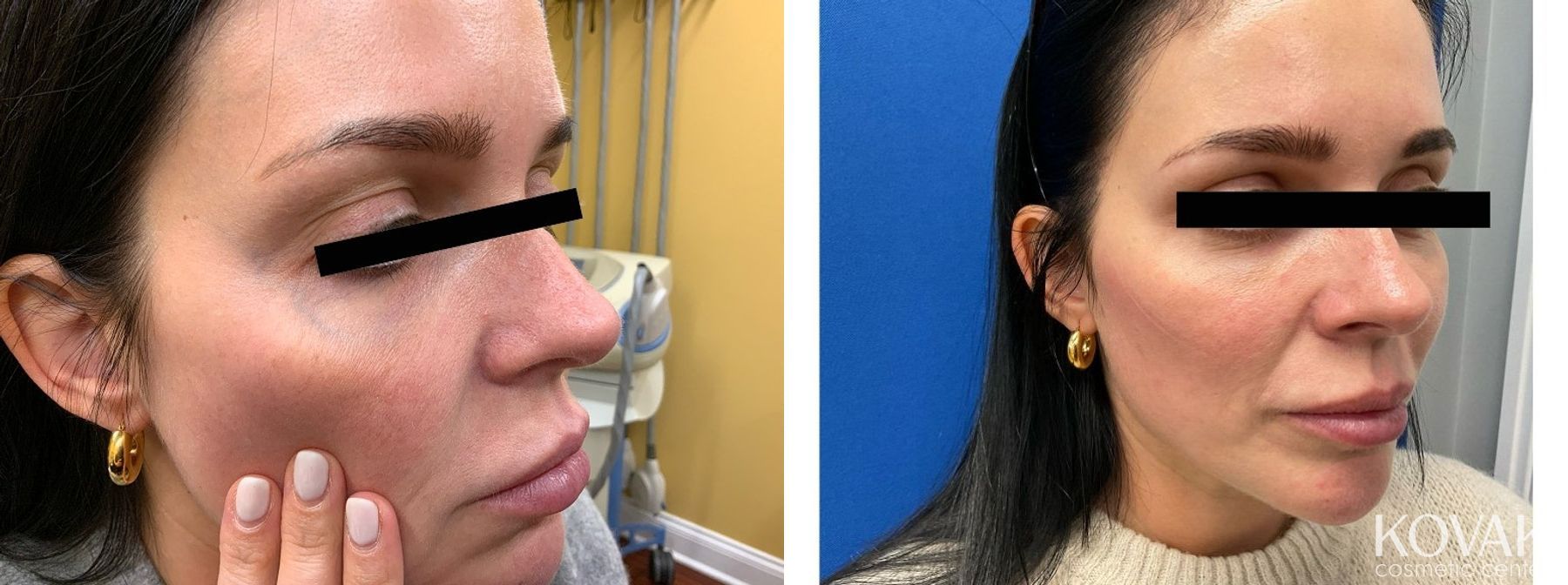 Before and after Eye Vein Treatment case 36757