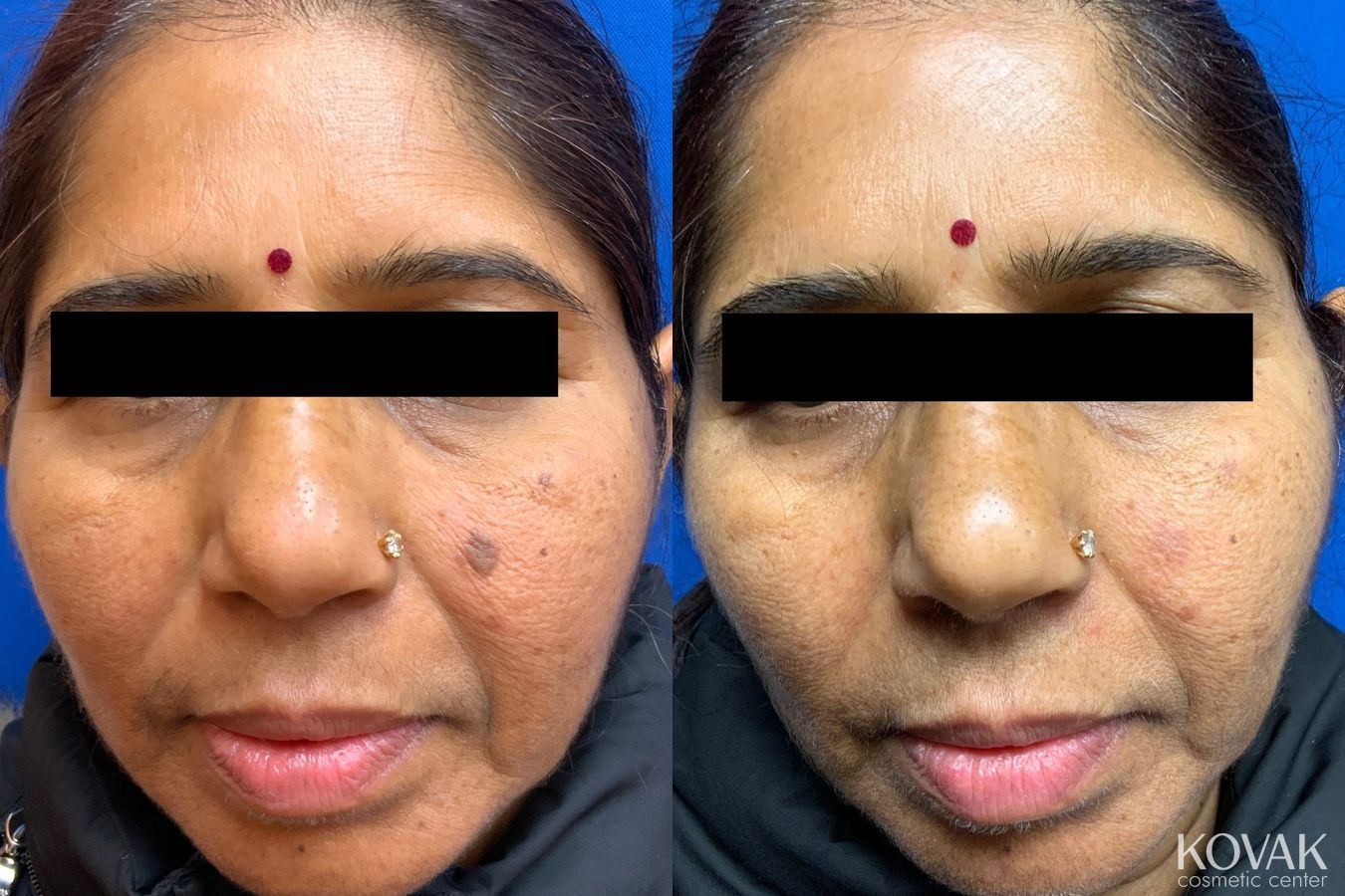 Before and after Mole Removal case 36742