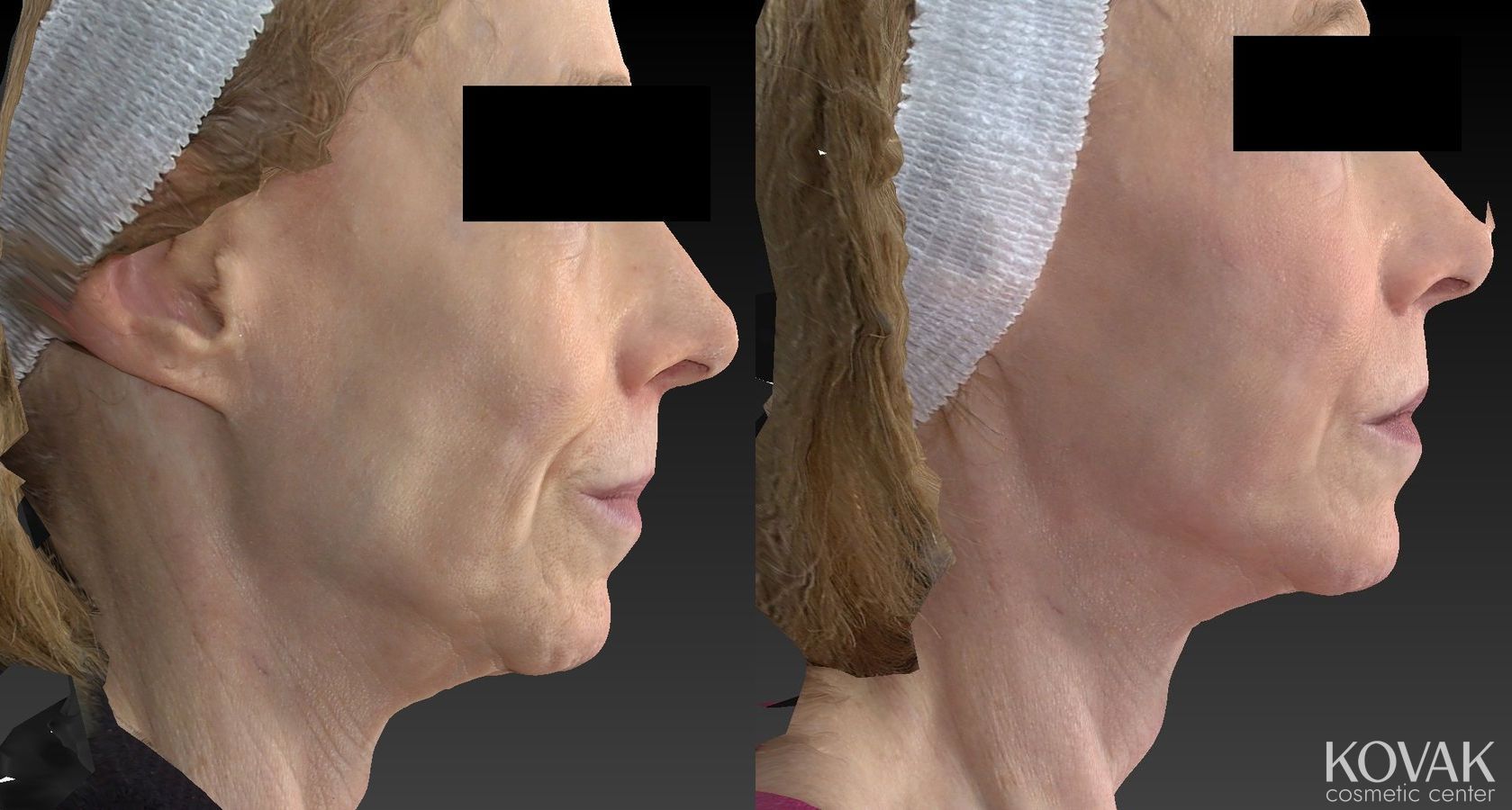 Before and after Sculptra® case 36464 - Angle 2