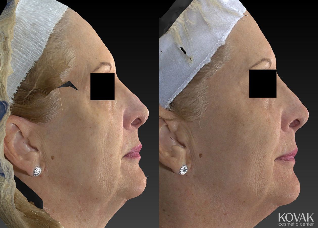 Before and after Sculptra® case 36618 - Angle 2