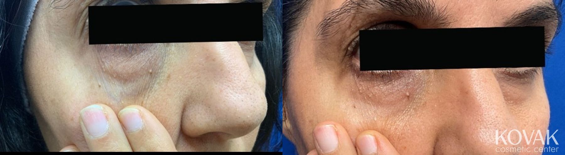 Before and after Eye Vein Treatment case 36729