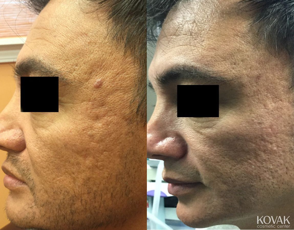 Before and after Juvéderm® XC case 36609