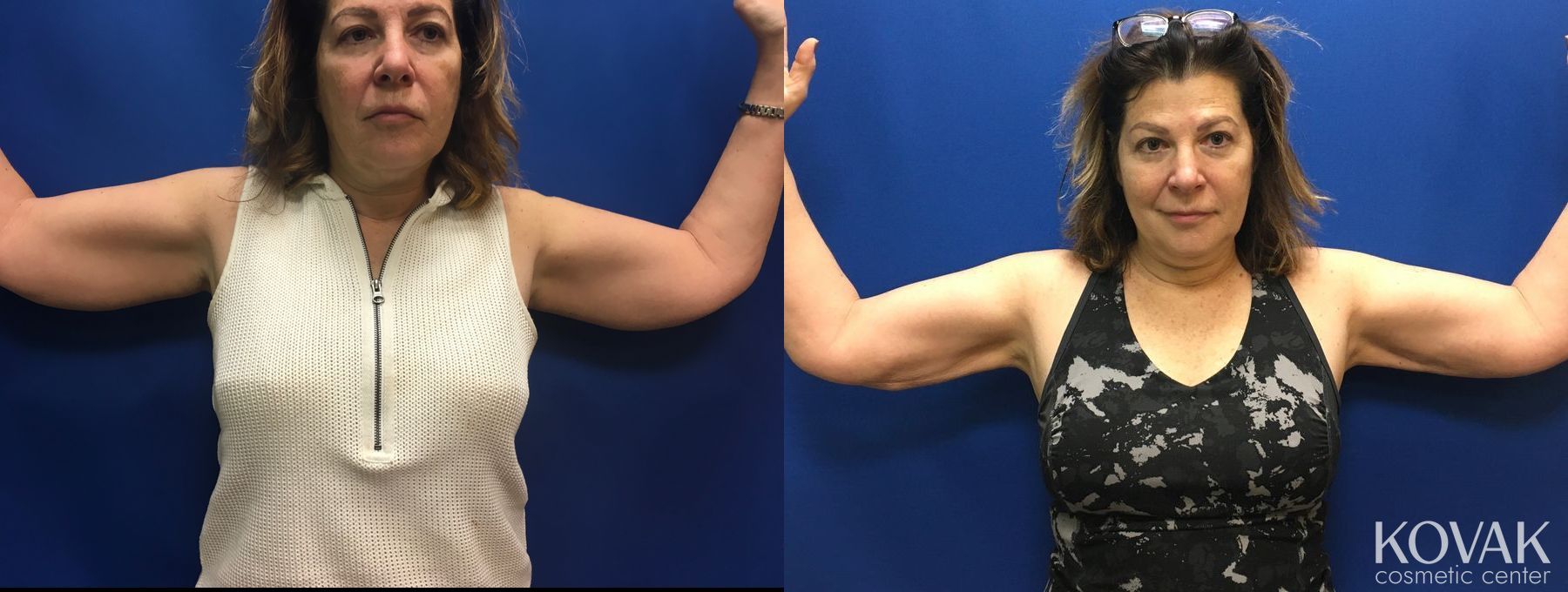 Before and after Laser Liposuction case 36681