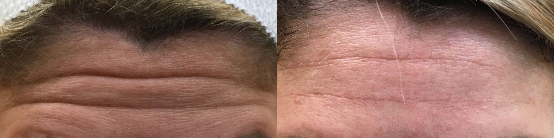 Before and after Forehead Lines case 36611