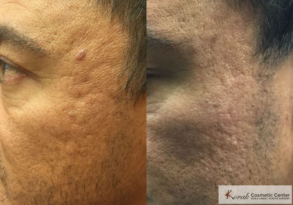 Acne Scars - Case 1570