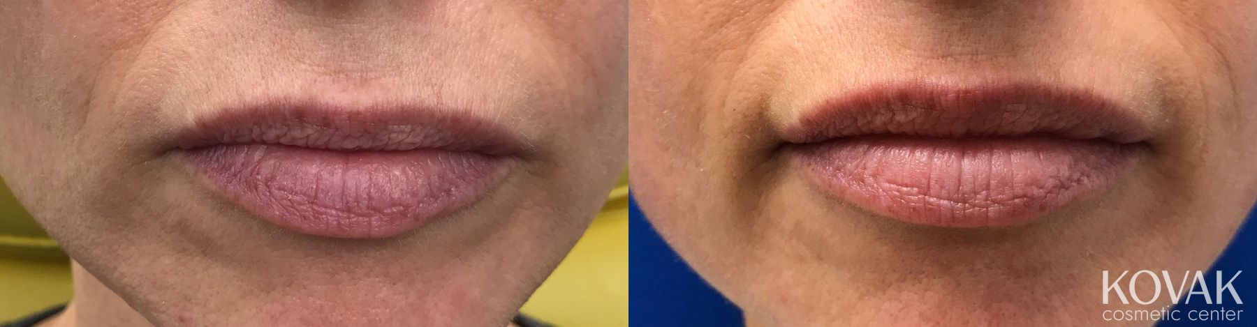 Before and after Restylane® Silk case 36548