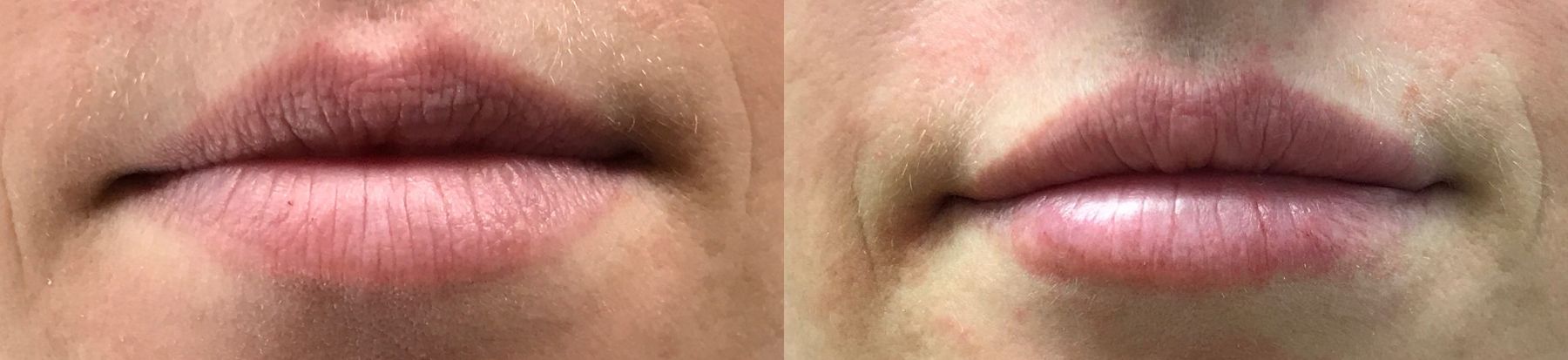 Before and after Lip Augmentation case 36603 - Angle 3