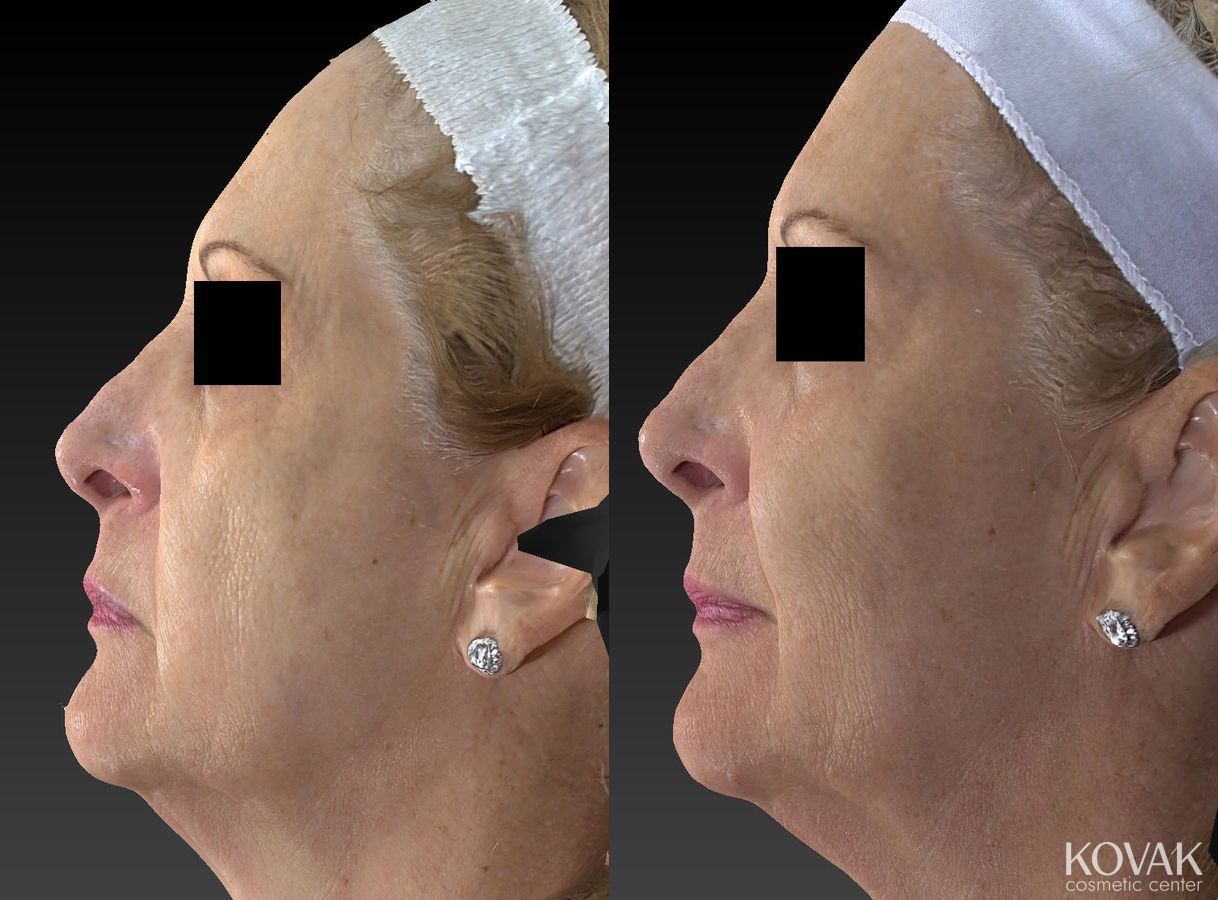 Before and after Sculptra® case 36618 - Angle 3