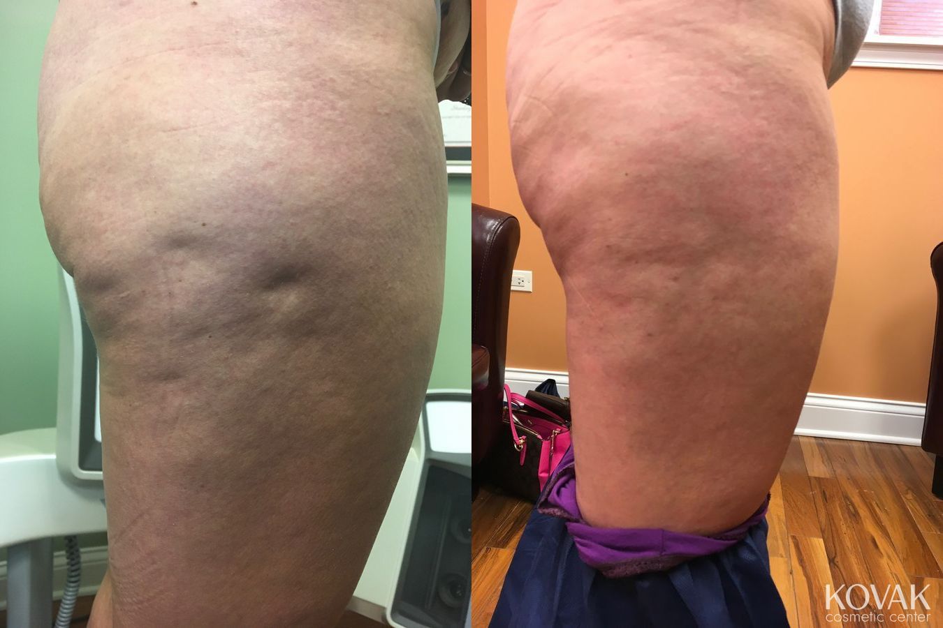 Before and after Cellulite Reduction case 36460 - Angle 3
