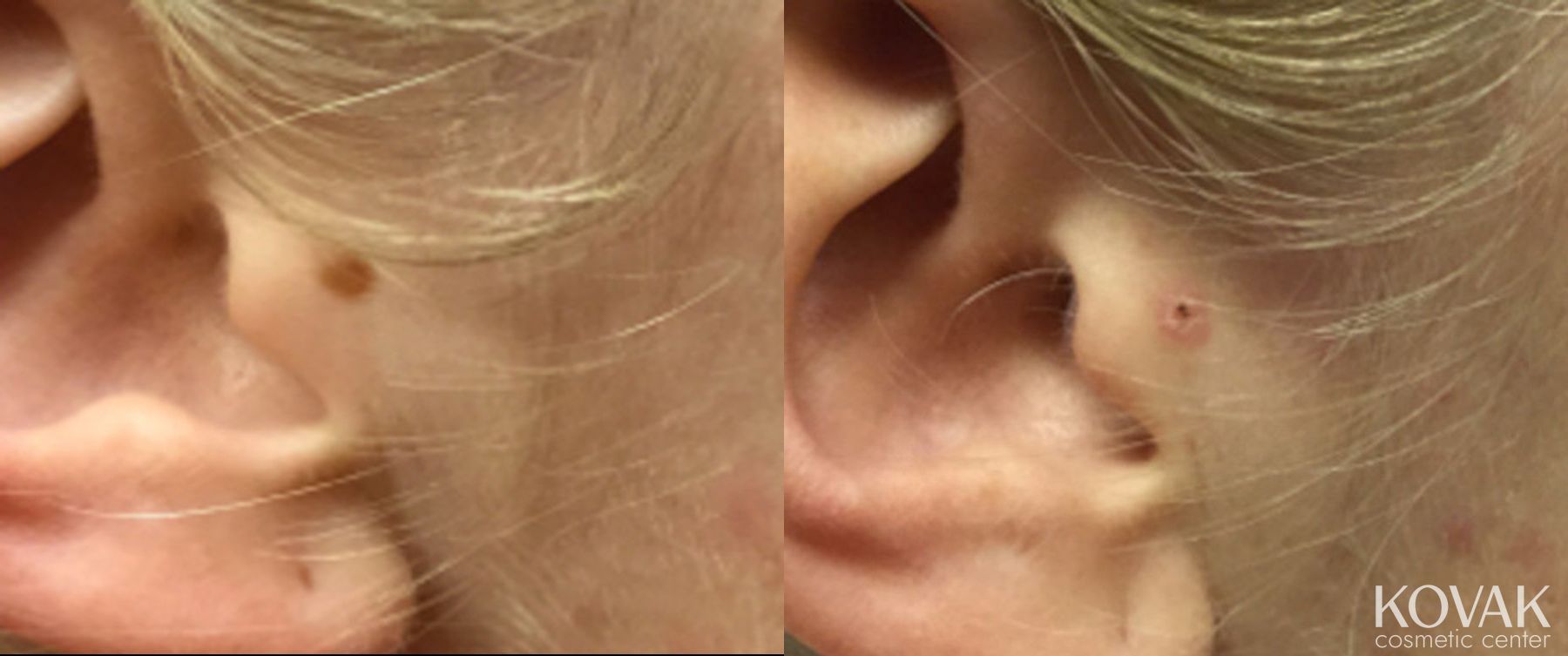 Before and after Mole Removal case 36508