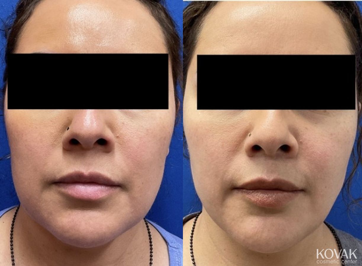 Before and after VLR - Vaser Laser - Jawline Sculpting case 36763 - Angle 3