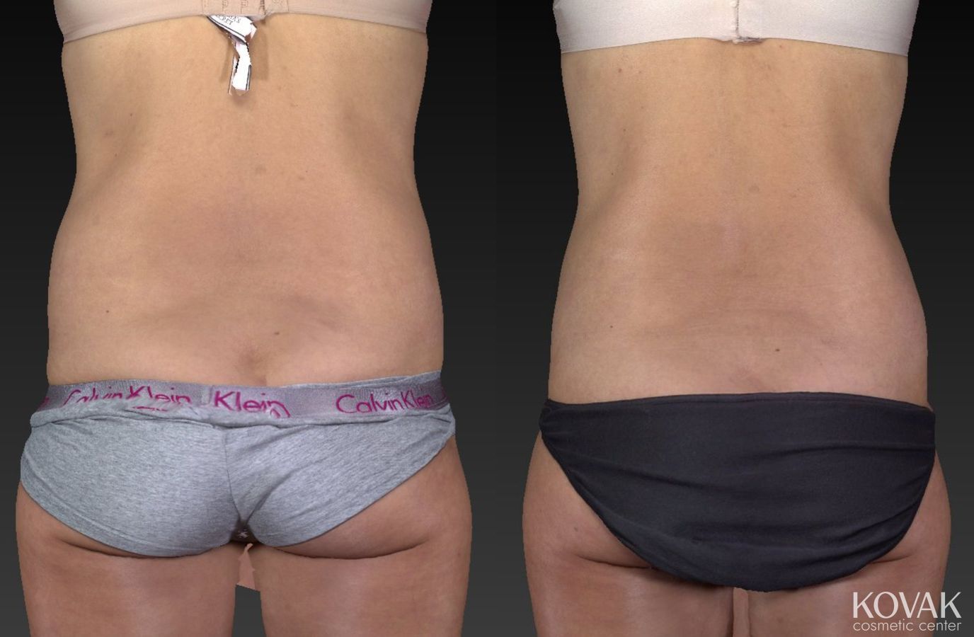 Before and after CoolSculpting® case 36580 - Angle 2